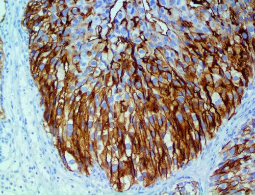 IHC of Uroplakin III Rpab on an FFPE Bladder TCC Tissue